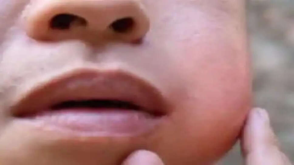 பொன்னுக்கு வீங்கி