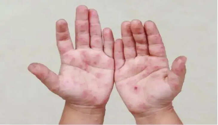 தட்டம்மை