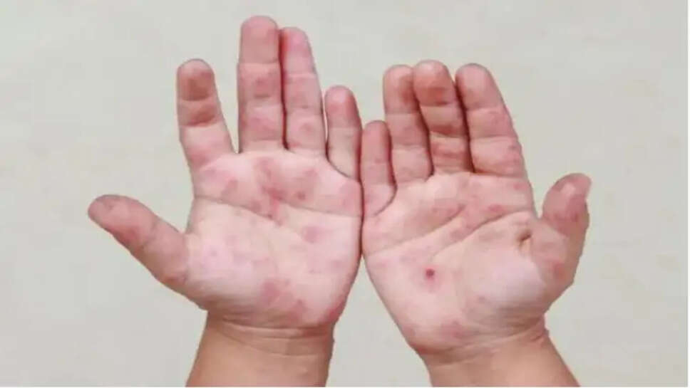 தட்டம்மை