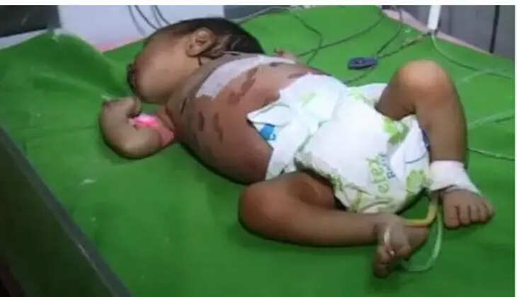 குழந்தை சூடு