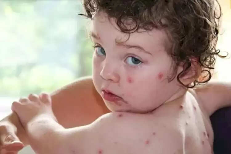 தக்காளி காய்ச்சல் குழந்தை