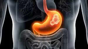 இரைப்பை கேன்சர்