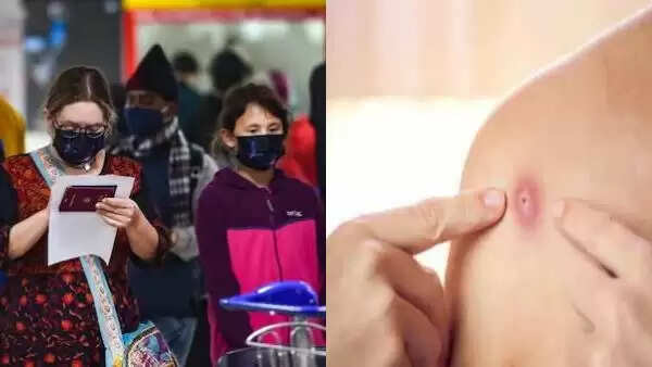 குரங்கு அம்மை