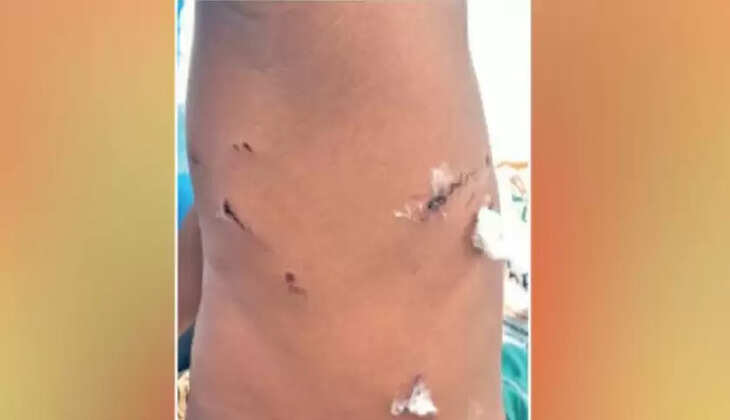 ரேட்வில்லர் நாய் கடித்து சிறுவன் படுகாயம்... கதறித் துடித்த பெற்றோர்!&nbsp;