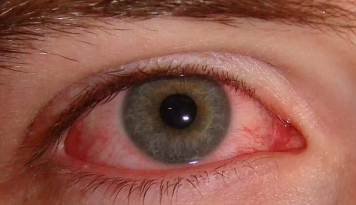 மெட்ராஸ் ஐ