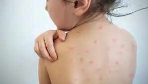 தட்டம்மை