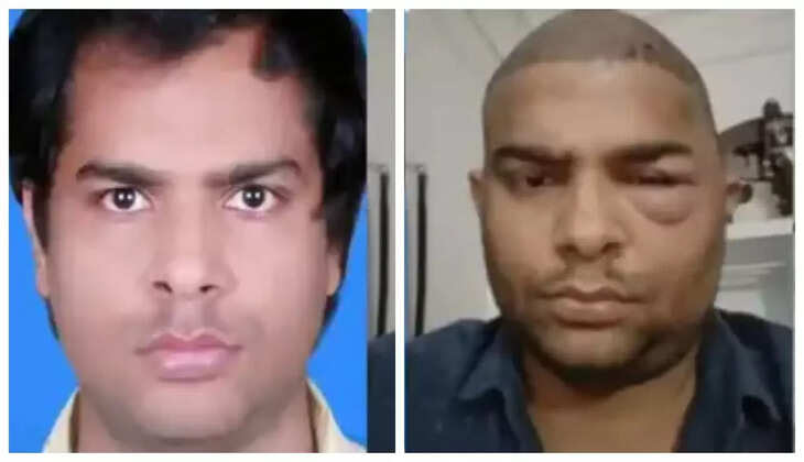 முடி மாற்று அறுவை சிகிச்சை