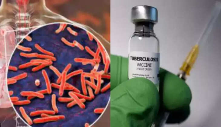 காசநோய்