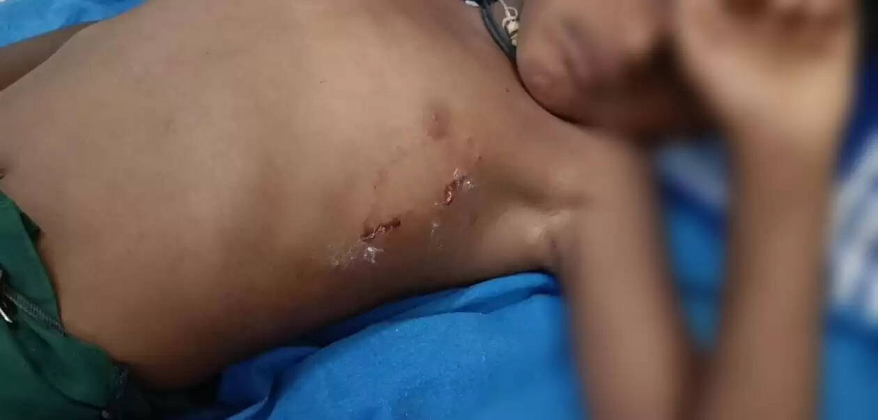 வெறிநாய்க்கடி நாய் வெறி