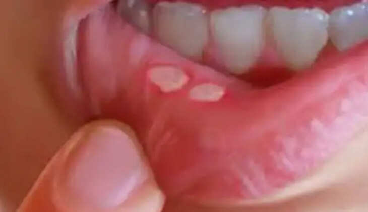 வாய்ப்புண்
