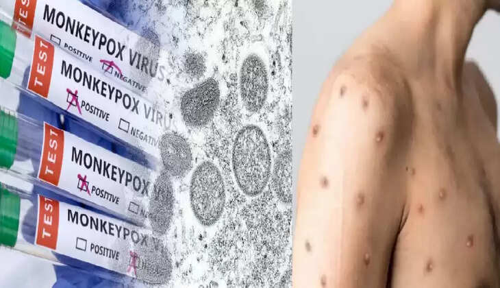 குரங்கு அம்மை