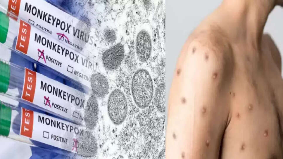 குரங்கு அம்மை