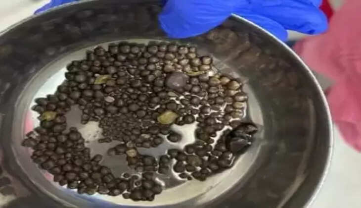 உலக சிறுநீரக தினம் | 27% சிறுநீரக செயல்பாடுகளால் அவதி... நோயாளியின் 418 சிறுநீரக கற்களை அகற்றி மருத்துவர்கள் சாதனை! எதனால் கற்கள் உருவாகிறது? எப்படி தடுப்பது?