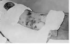 காங்கோ காய்ச்சல்