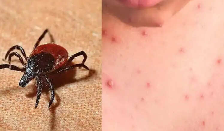 உண்ணி காய்ச்சல்