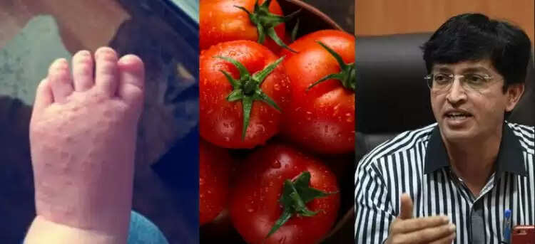 தக்காளிக் காய்ச்சல்