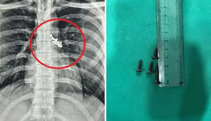 நுரையீரல் வயிறு ஆணி எக்ஸ்ரே