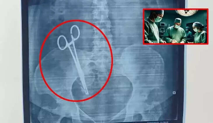 பிரசவத்தில் மருத்துவரின் அலட்சியம்... 17 ஆண்டுகளாக பெண்ணின் வயிற்றில் இருந்த கத்திரிக்கோல்!