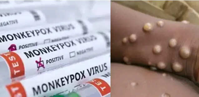 குரங்கு அம்மை