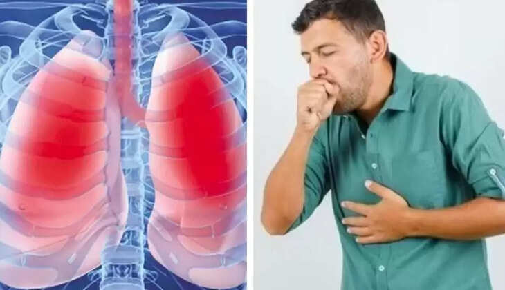 காசநோய்