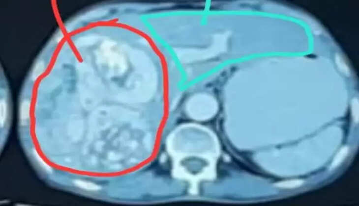 புற்றுநோய் கட்டி 