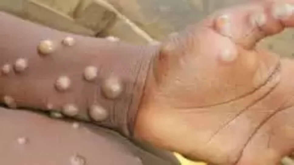  குரங்கம்மை 