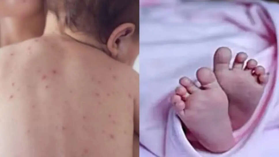 தட்டம்மை