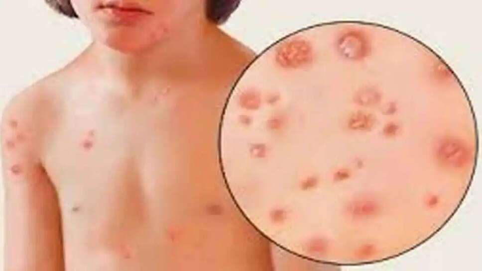 சின்னம்மை அம்மை