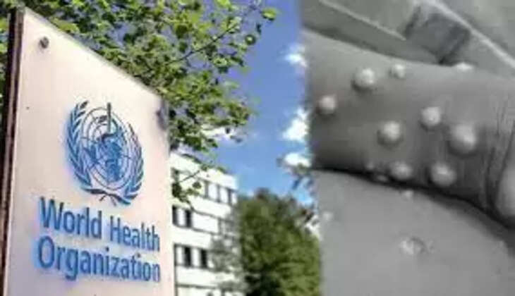 குரங்கு அம்மை