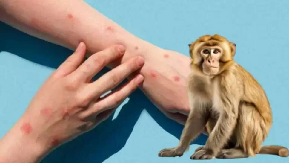 குரங்கு காய்ச்சல்