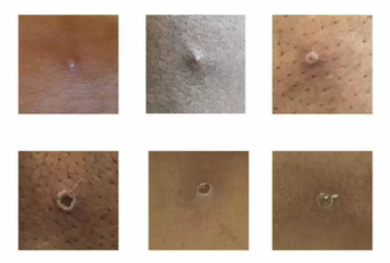 குரங்கு காய்ச்சல்