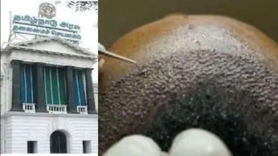 முடி மாற்று சிகிச்சை ஹேர்