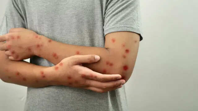 குரங்கம்மை