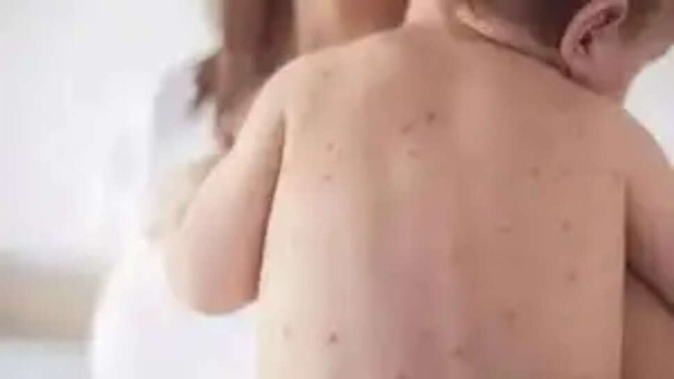 தட்டம்மை