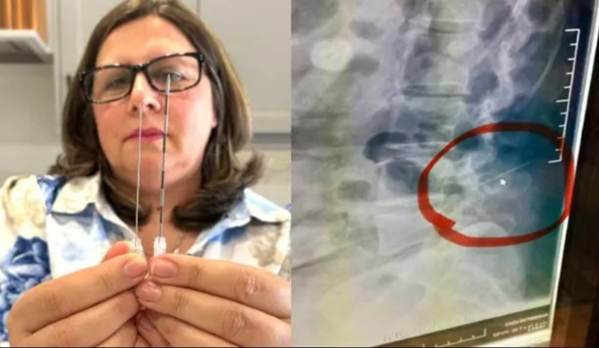 பெண் முதுகெலும்புக்குள் உடைந்த ஊசி …. எக்ஸ்ரேவில் அதிர்ச்சி!