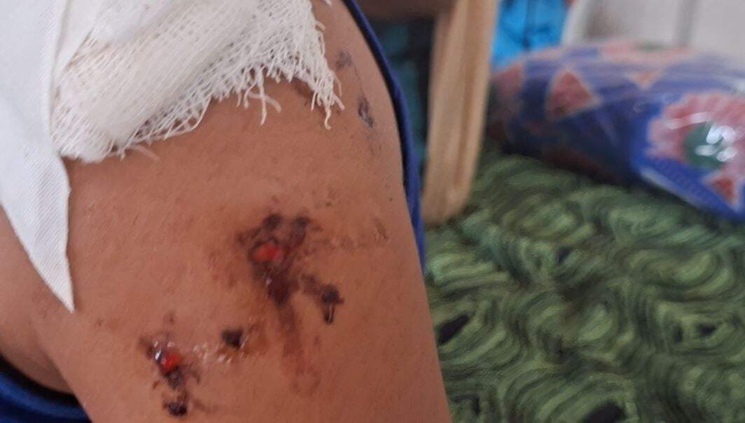 அடுத்த அதிர்ச்சி... தொடரும் அவலம்... 10 வயது சிறுமியை கடித்து குதறிய வளர்ப்பு நாய்!