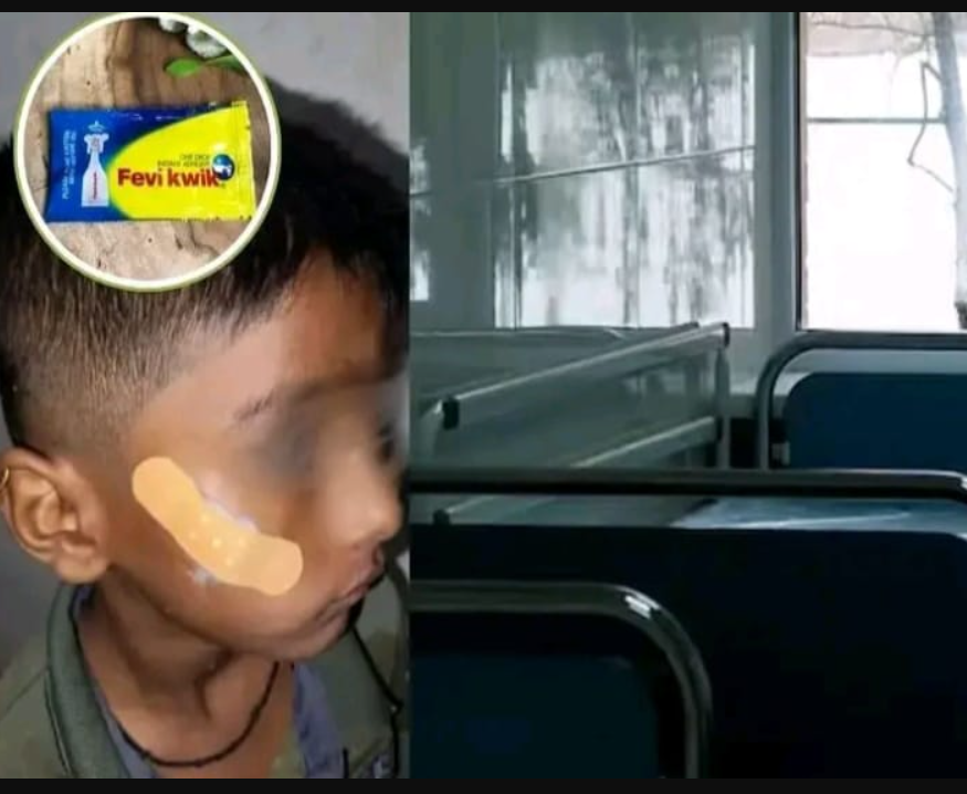 பகீர்... கதறித் துடித்த சிறுவன்... காயத்திற்கு மருந்து போடாமல் பெவி குயிக் தடவிய நர்ஸ்... !