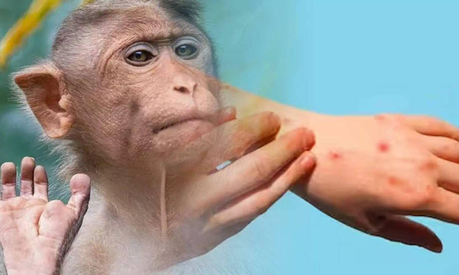 குரங்கு அம்மை