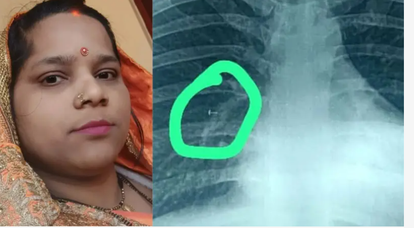 அதிர்ச்சி... 17 ஆண்டுகளாக பெண்ணின் நுரையீரலில் சிக்கிய மூக்குத்தி!