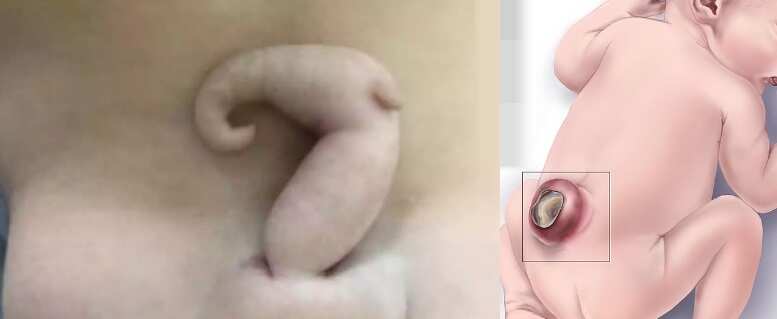 வாலுடன் பிறந்த பெண் குழந்தை... 6 செ.மீ நீளம் வளர்ந்ததால் மருத்துவர்கள் குழப்பம்!