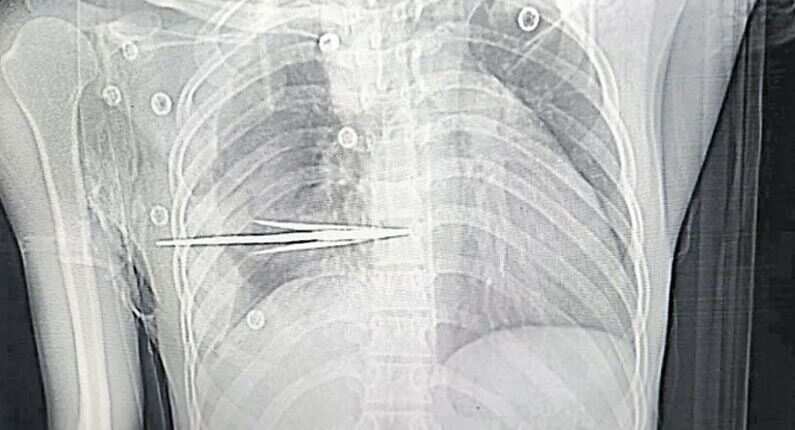 பெரும் அதிர்ச்சி.. நெஞ்சில் சொருகிய அம்பு.. சரியான நேரத்தில் சிறுவனை காப்பாற்றிய மருத்துவர்கள்!