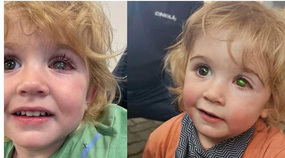 பெற்றோர்களே உஷார்... 2 வயது குழந்தைக்கு முத்தம் காரணமாக கண் பார்வை இழப்பு !