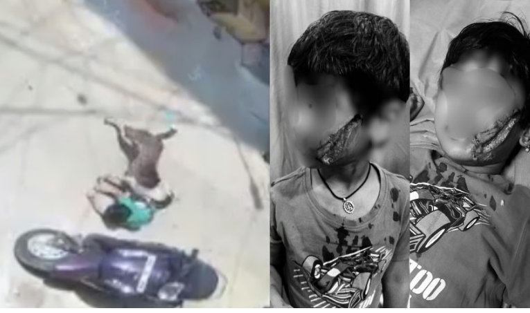 பகீர் வீடியோ... சிறுமியை கடித்து குதறிய தெருநாய்... பள்ளிக்குச் சென்ற போது விபரீதம்!