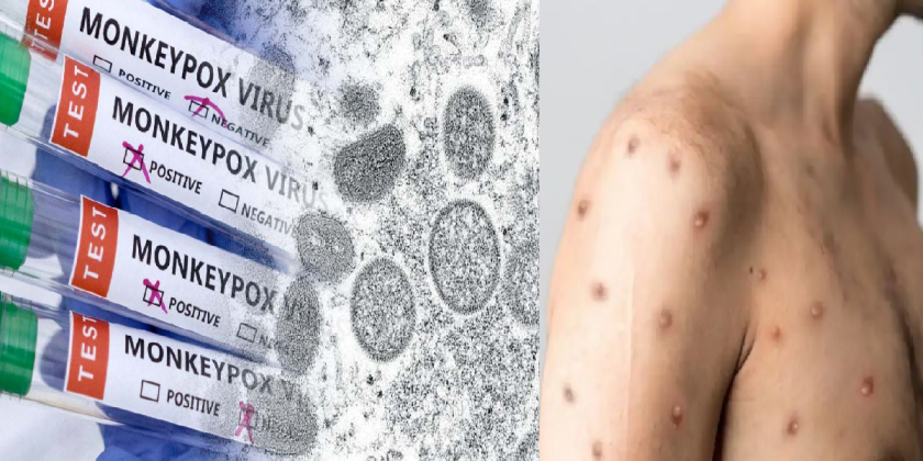 அதிர்ச்சி!! இந்தியாவின் முதல் ”குரங்கு அம்மை” பதிவு!! தனிமைப்படுத்தப்பட்ட மாணவர்!!