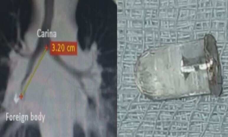 அதிர்ச்சி.. 5 வயது சிறுவனின் நுரையீரலில் சிக்கிய எல்இடி பல்பு!