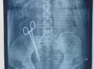 17 ஆண்டுகளாக பெண் வயிற்றுக்குள் கத்தரிக்கோல்!