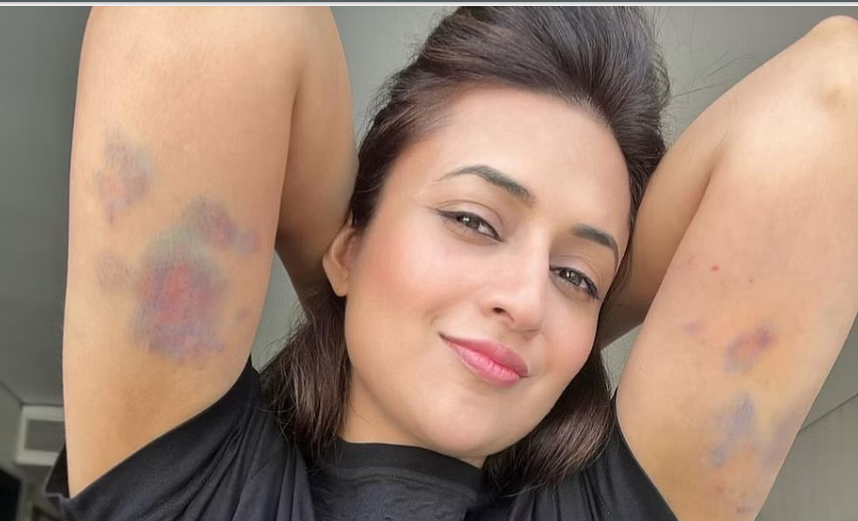 பிரபல சின்னத்திரை நடிகைக்கு படுகாயம்.. வைரலாகும் இன்ஸ்டா!!