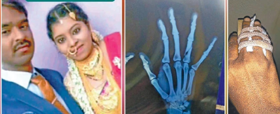 அடுத்தடுத்து 3 பெண்குழந்தைகள் !! மனைவியின் விரல்களை உடைத்து தனி அறையில் அடைத்து சித்ரவதை!!