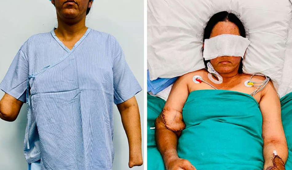 மருத்துவ அதிசயம்... விபத்தில் கைகளை இழந்த பெண்ணுக்கு மறுவாழ்வு... டெல்லி டாக்டர்கள் செய்த மாபெரும் சாதனை!