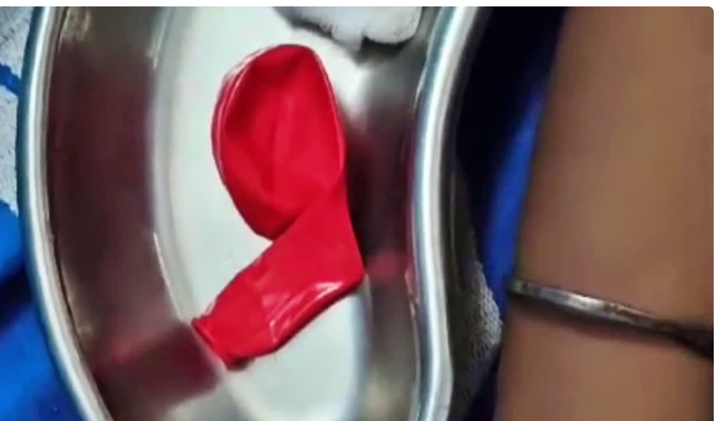 பெற்றோர்களே உஷார்... 13 வயசு தான்... பலூன் வெடித்து மூச்சுத்திணறலால் உயிரிழந்த சிறுவன்!